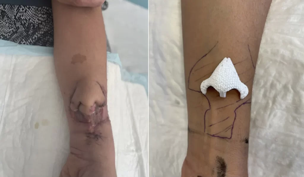 Surgeons In France Successfully Transplant Nose Grown On Woman's Arm To Her Face